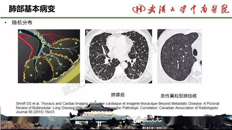 肺部影像解剖及基本概念,基本病变