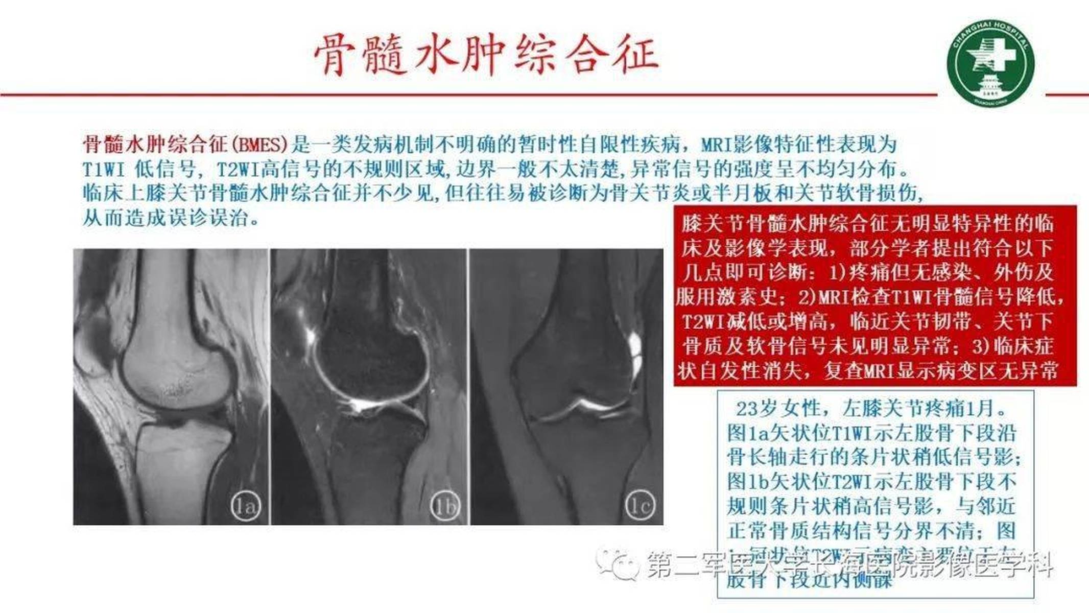 膝关节骨髓水肿的mri影像表现