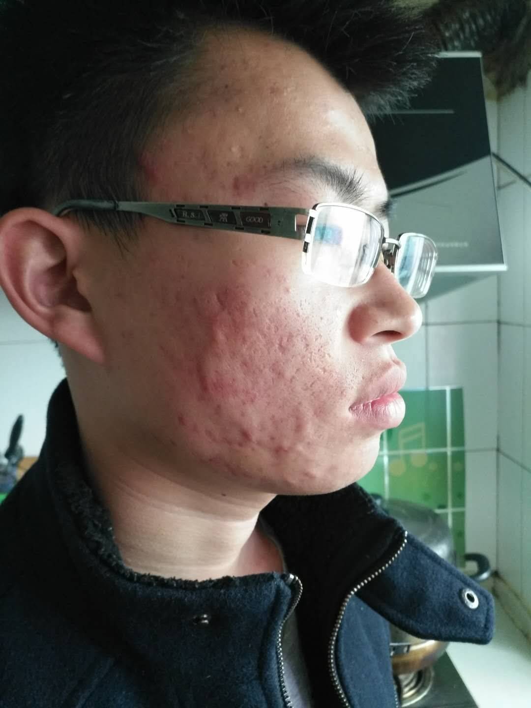 这样的皮肤油腻状况,时间久了