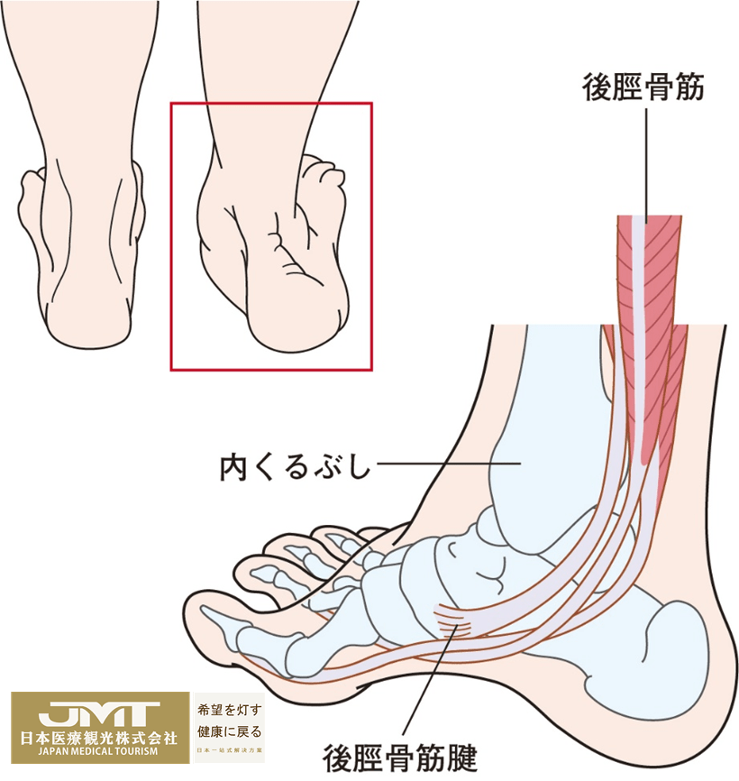 随着年龄的增长和扭伤,位于内脚踝后面的胫后肌腱发生变化而发生断裂