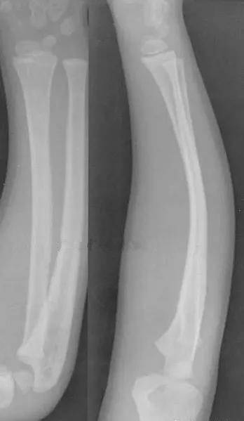 4,骨骺损伤(epiphyseal injuries)