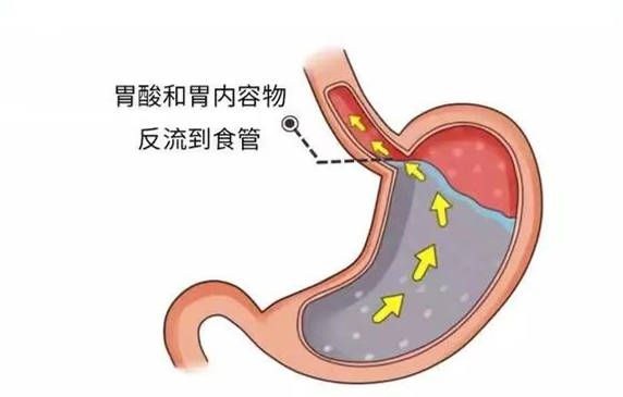 主要是指胃内容物反流至食管引起的烧心,反酸,烧灼感等不适症状及并发