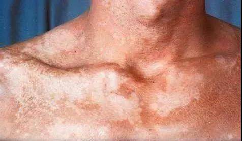 种常见的由马拉色菌毛囊炎(也称糠秕孢子菌)所引起的浅表真菌性皮肤病