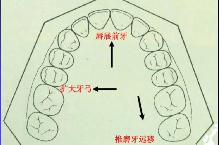 新疆臻美口腔矫正牙齿必须拔牙吗