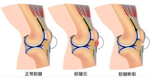 髌骨别跑,一篇文章全面了解髌骨脱位