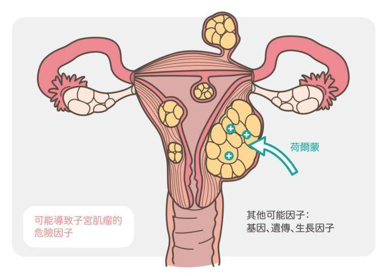 子宫肌瘤的常见原因有3类,宫茹清科普针对预防
