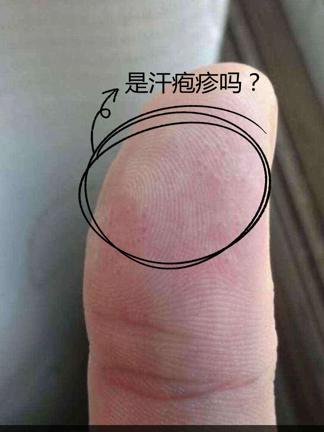 手指上有很多透明小水泡,是汗疱疹吗?_皮肤
