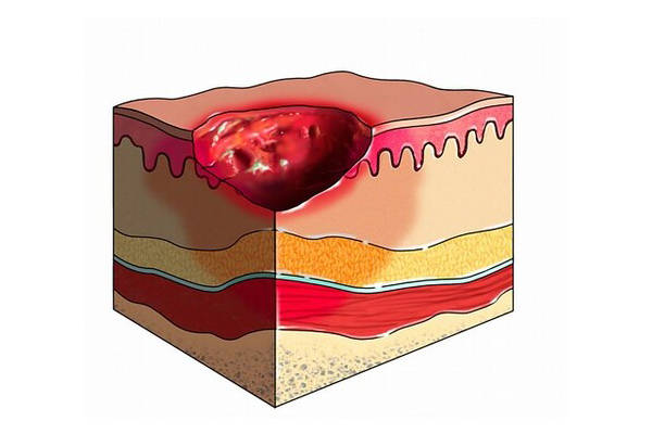 (三)褥疮重度:黑痂或皮下空腔伤口发生明显的溃疡后,没有采取及时有效