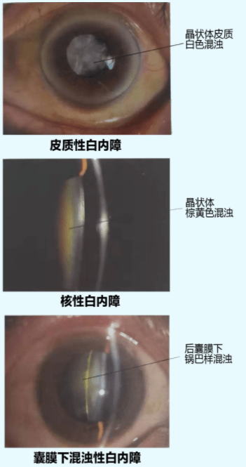 通常,白内障根据晶状体混浊的部位可分为皮质性,核性及囊膜下混浊性3