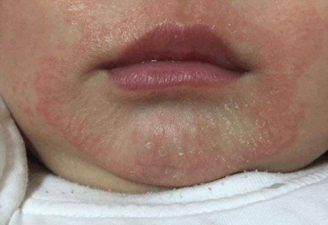 湿疹和口水疹的区别 口水疹是湿疹的一种.