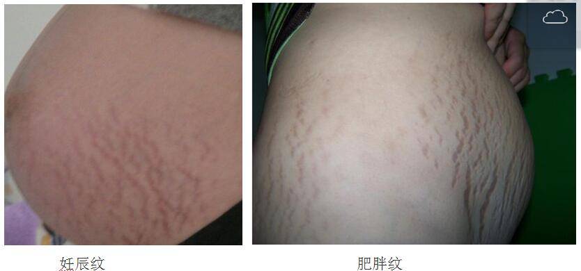 针对妊辰纹或肥胖纹的治疗,上海谷舒光电科技有限公司李医生分享给