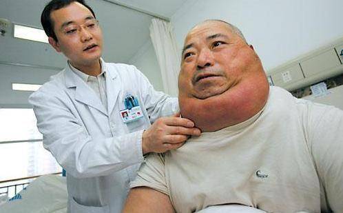 治疗"河马脖"目前除了手术外,暂时没有特别有效的治疗方法.