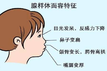 首大石萍:孩子腺样体肥大会有哪些症状_影响_儿童_治疗