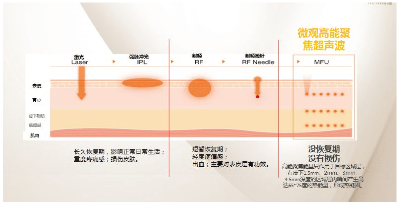 超声炮是什么美容项目作用原理是什么