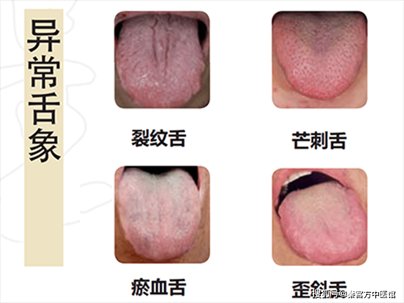 望舌质,舌苔是舌诊的重要内容,因其在疾病诊治中具有十分重要的含义.