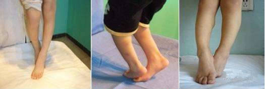 (图三)外翻足症状(图二)马蹄足症状(图一)尖足症状当孩子一岁多,两岁