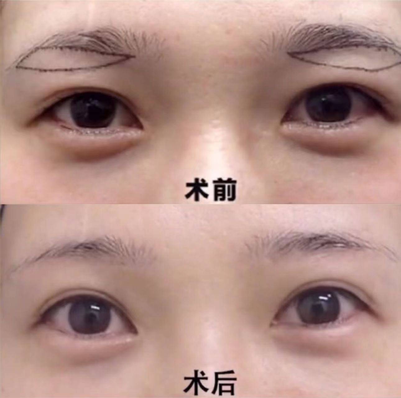 提眉是什么样的整容手术提眉可以改善什么问题