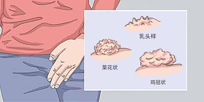 原标题：私处长了小疙瘩，警惕HPV感染尖锐湿疣！