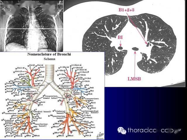 推荐| ct支气管解剖