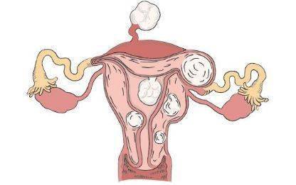 没有预示,为什么就患上了子宫肌瘤?