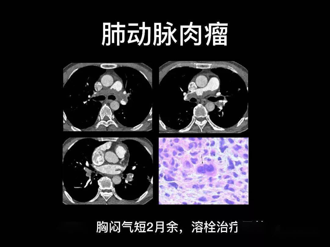 肺栓塞的影像诊断与鉴别诊断