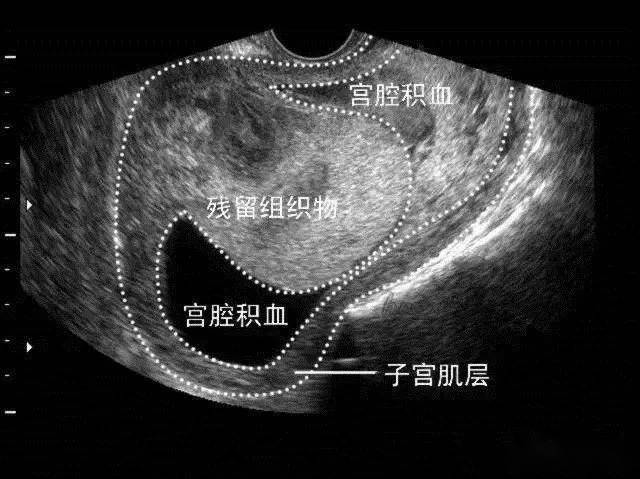 图5 稽留流产胎盘水泡样变 四,不全流产 临床表现:妊娠囊已排出,宫腔