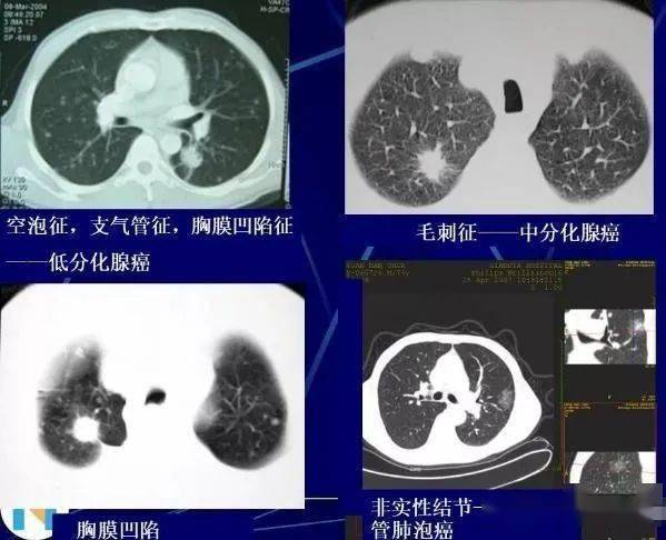 医生是如何通过影像资料,观察肺结节,发现肺癌的?看完