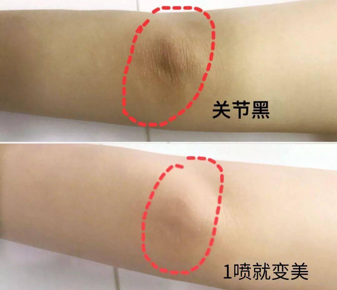 夏天不露腿原来是皮肤拖后腿