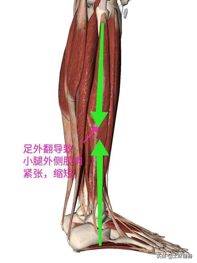 然后我们再从侧面观察下正常足弓与外翻状态下小腿侧面肌肉的状态