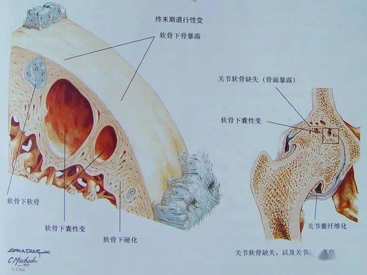 骨质变化:骨质硬化—象牙样变,软骨下骨板囊性变;关节边缘软骨过度