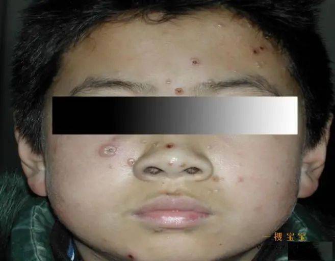 来自市南区教育和体育局的健康小贴士:远离水痘