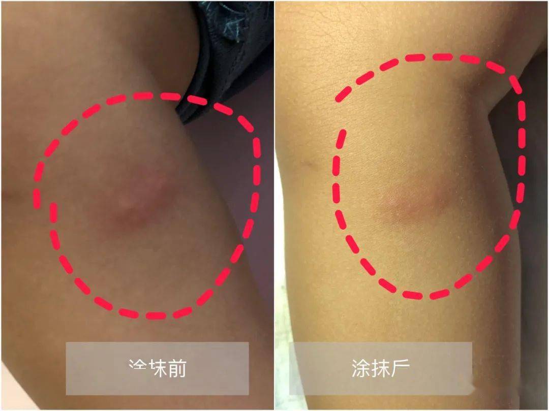 怎么抓蚊子效果最好 910f2ce0f9844cfc97990b10f70466f3.jpeg