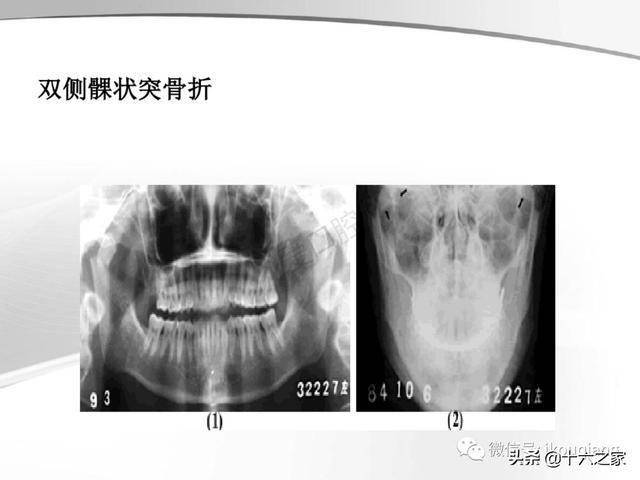 牙及牙周各种疾病影像学表现整理