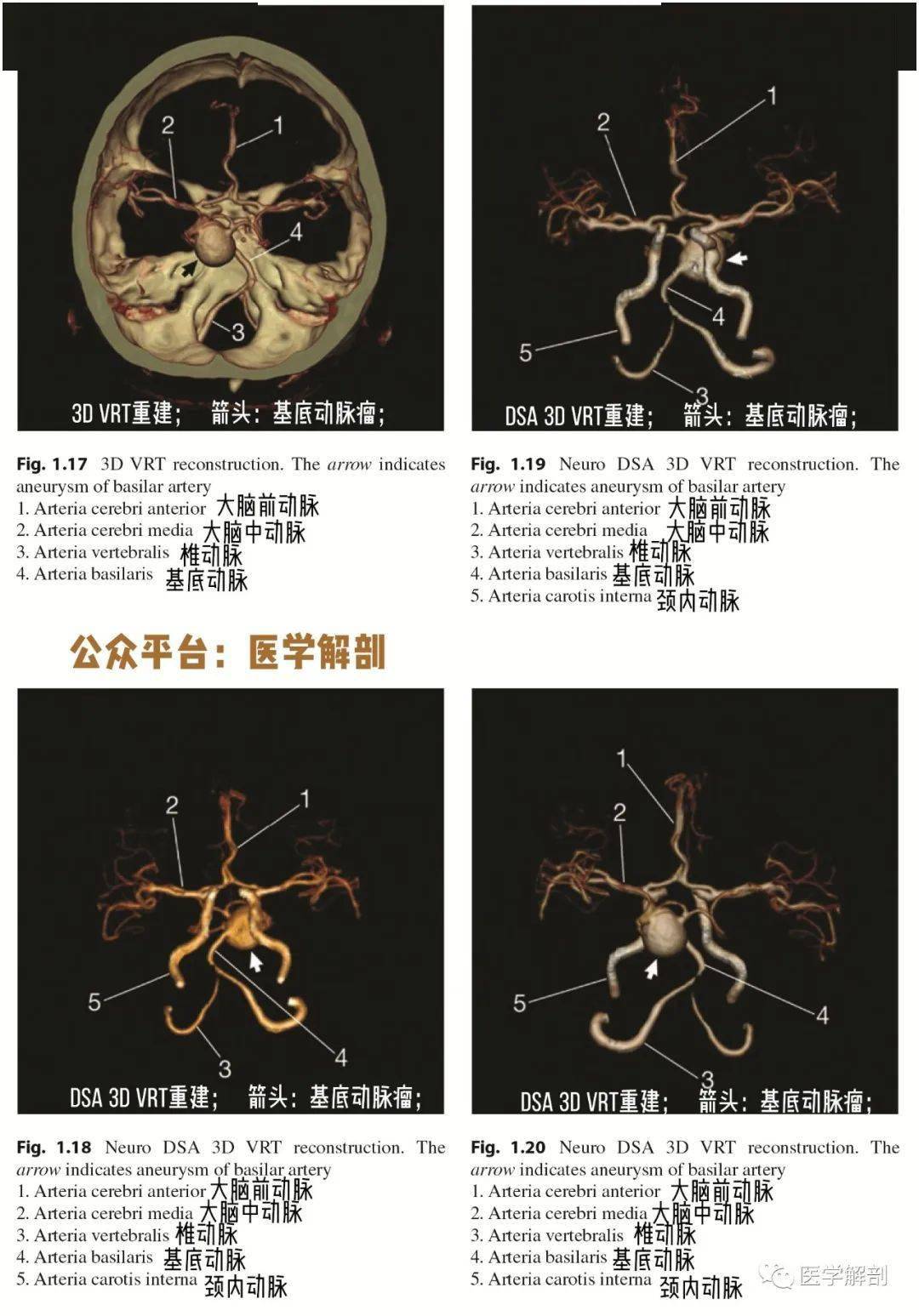 脑cta图谱 | 基底动脉瘤