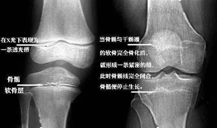 同龄人|娃比同龄人矮，要不要打生长激素？父母不高