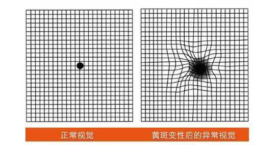 家里老人视物变形别忽视!小心是得了这种致盲眼病!_黄斑