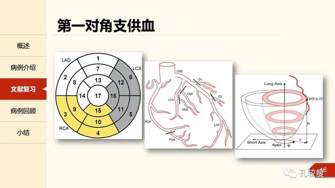 南非国旗征一种判断对角支闭塞的心电图表现