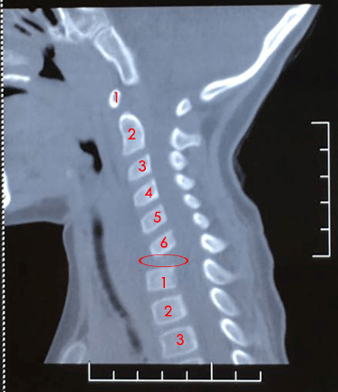 颈椎ct:红圈所在位置为琦琦(化名)缺失的颈7椎体(图:广医三院骨科)