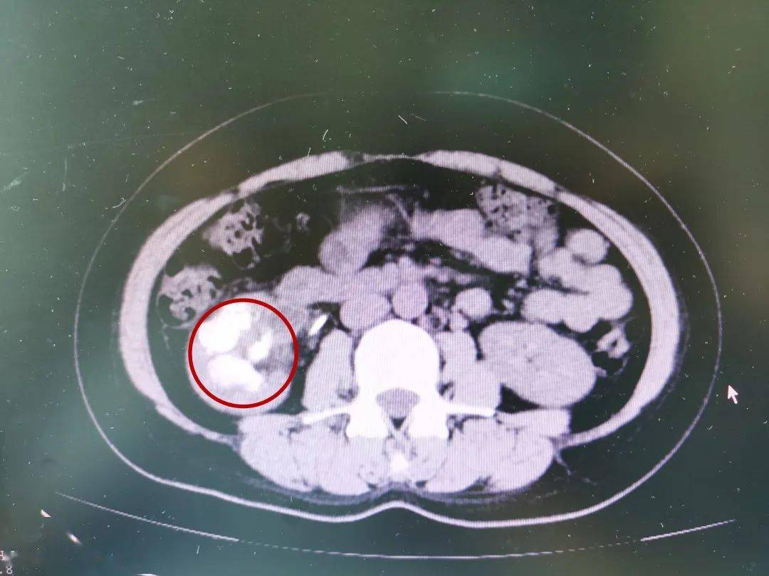 小石头差点要了她的命,38岁女子肾结石引发重症感染