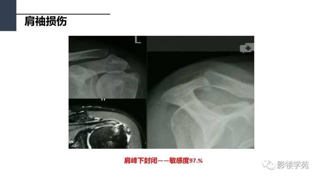 肩关节解剖及常见疾病影像表现