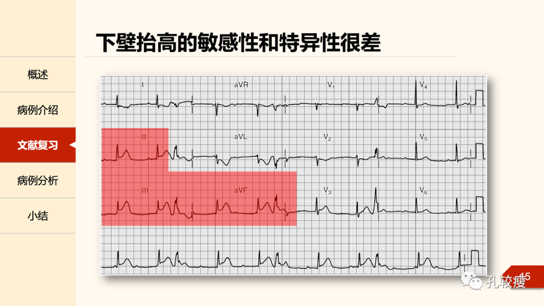 如何巧用avl导联诊断下壁心肌梗死