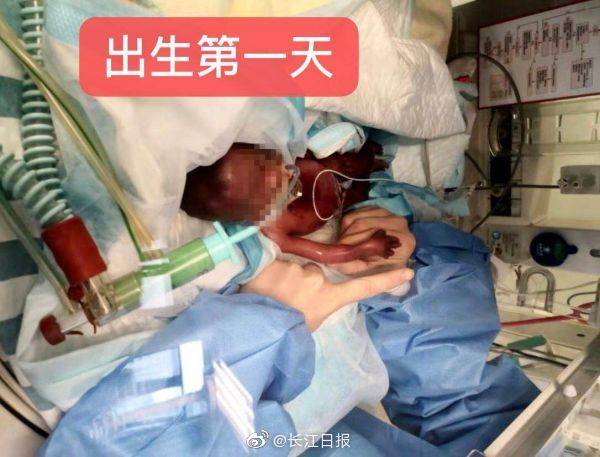 救治|出生仅500克的巴掌宝宝出院啦！曾3次遭遇死亡威胁