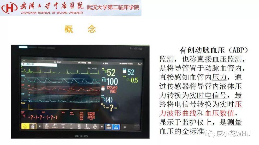 如何做好有创动脉血压监测及其波形分析?史上最详细的