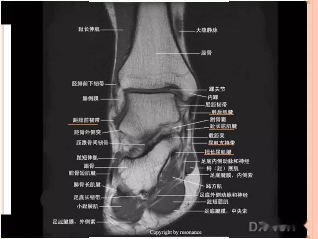 踝关节mri解剖和常见损伤类型