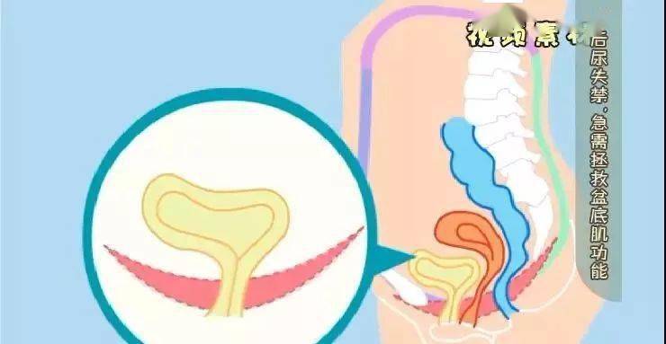 产后尿失禁是盆底肌出了问题