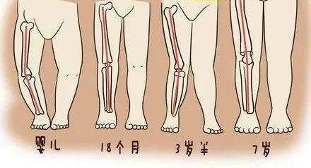 "我家宝宝才刚学会走路 就已经看出来有明显的  o型腿了!