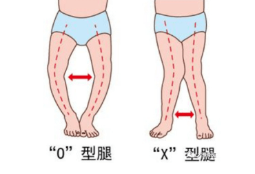 儿童罗圈腿长短腿不可怕微创治疗有办法小儿骨科Ⅱ脊柱侧弯科11周年