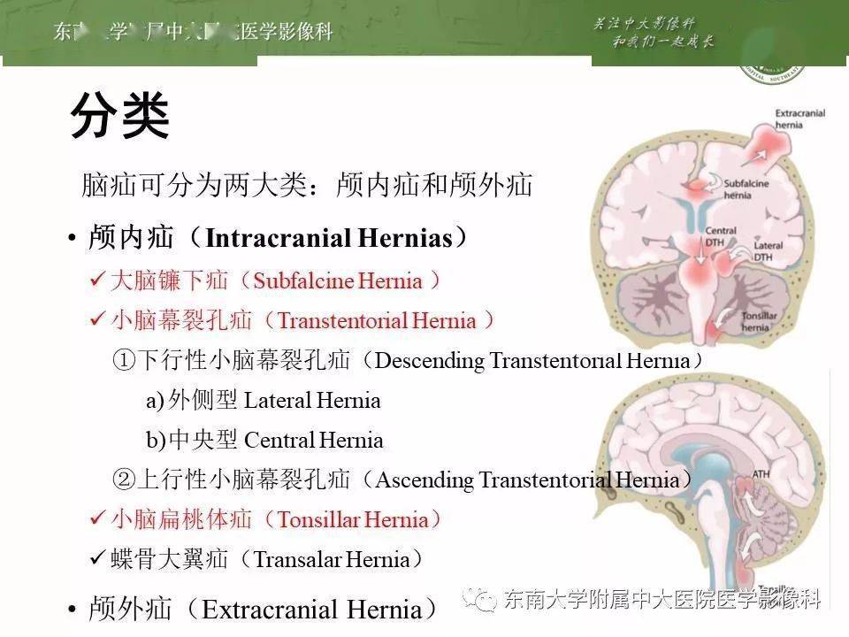 必点收藏 | 颅内疝影像汇总