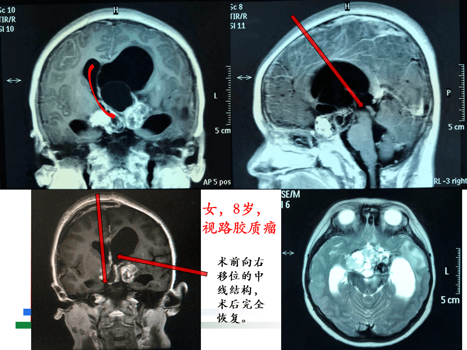 解剖课件 | 儿童鞍区肿瘤常见手术入路- 北京儿童医院葛明