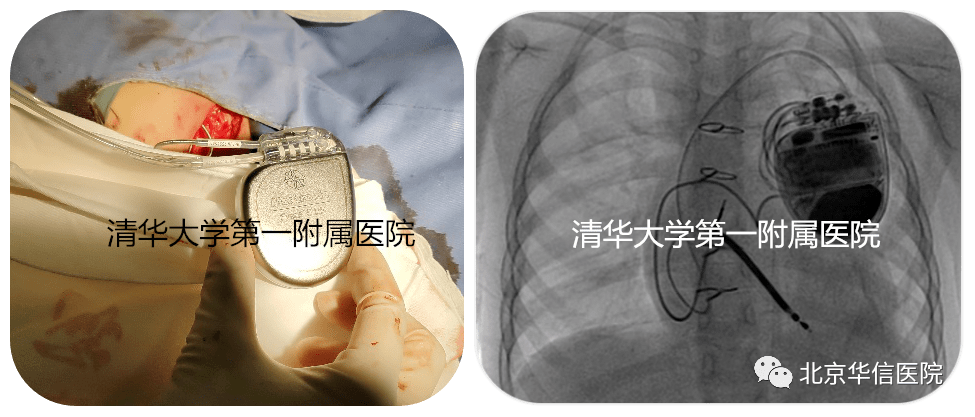 心脏中心小儿科首创杂交术式植入双腔icd并松解肌桥,创国内最小年龄